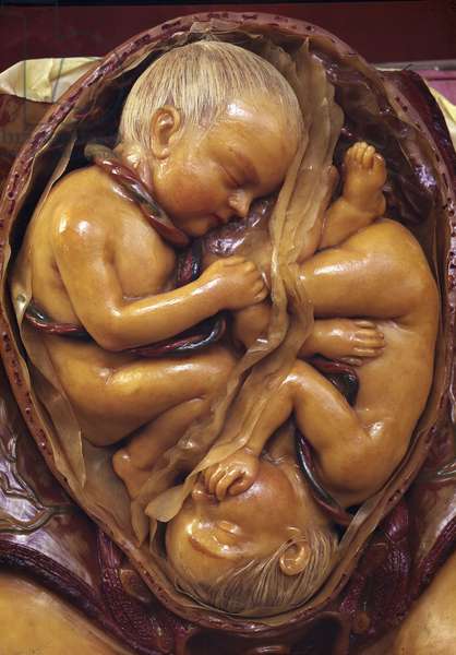 Model of twins in the womb (wax) by Susini, 