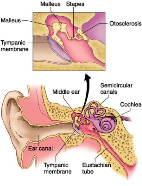 Otosclerosis fixing the stapes bone in the middle ear 