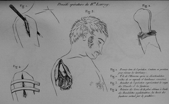 sketch detailing a shoulder amputation