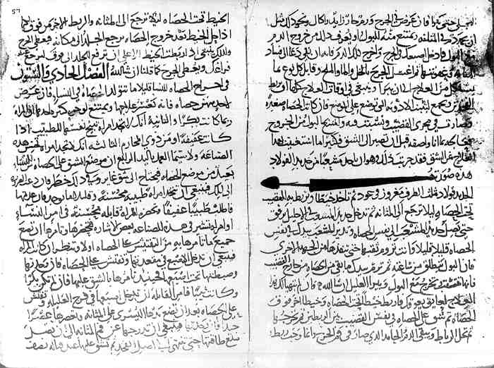 A manuscript page of the 30th section of Al-Tasrif book of Al-Zahrawi (the first ever illustrated operative surgical book) showing the instrument and technique he devised to crush an impacted urethral stone, avoiding the need to cut on it.