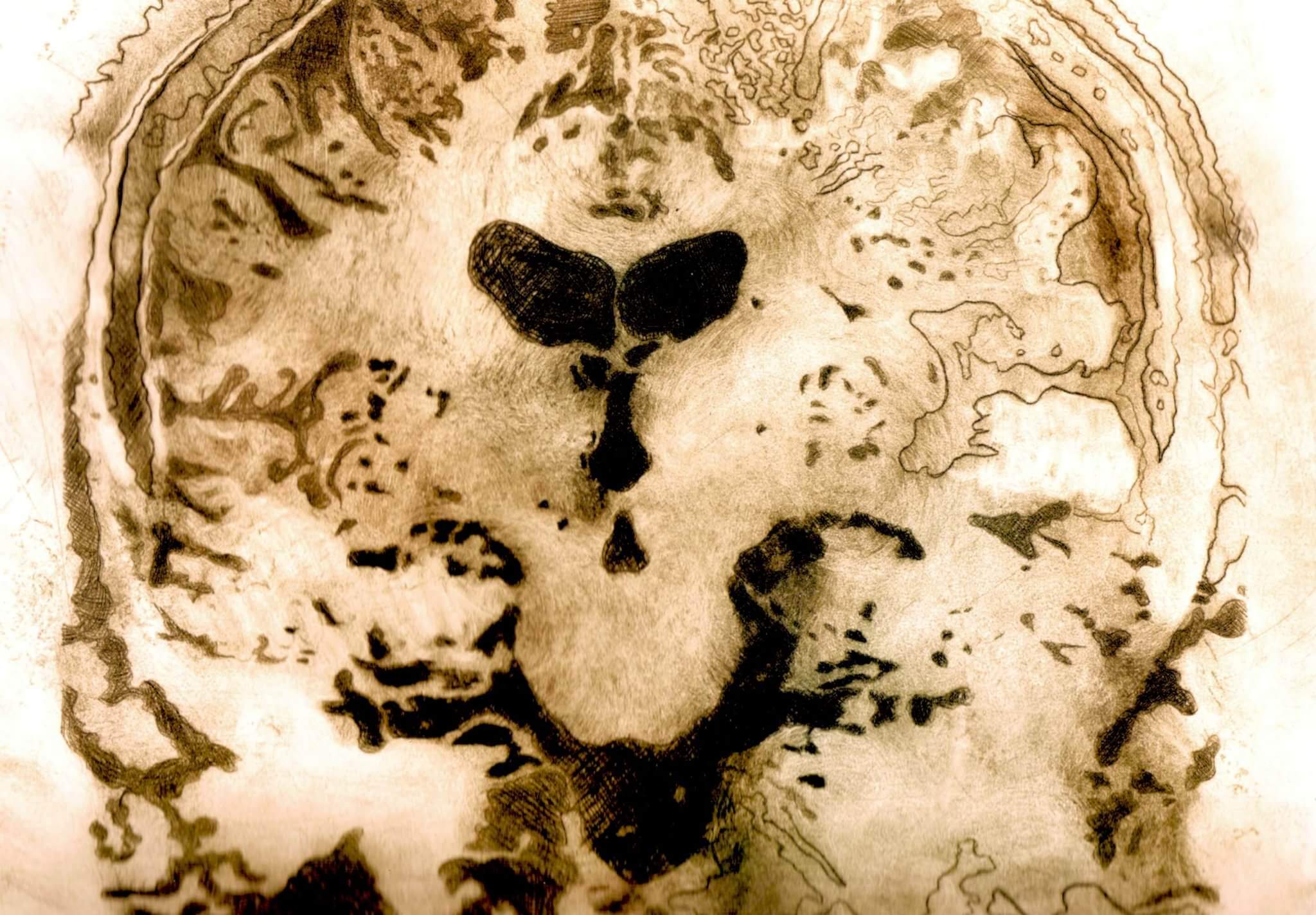 Dry point etching of a brain. Courtesy of Nod Ghosh.