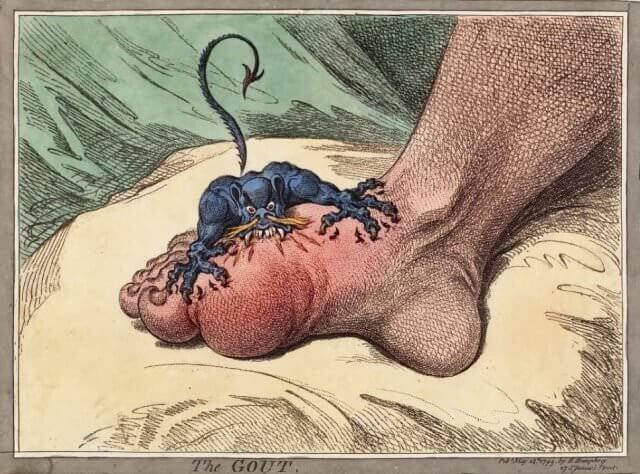 Gout represented as a demon biting a man's foot