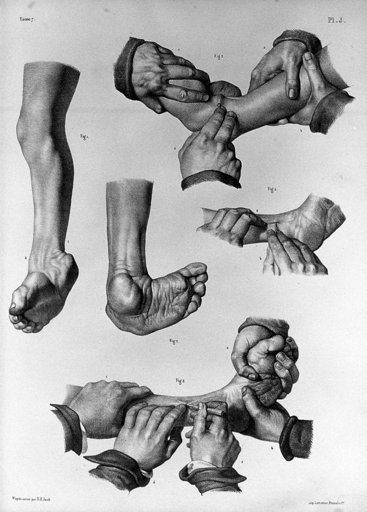 Drawings of a clubbed foot alone and held by surgeons at different angles