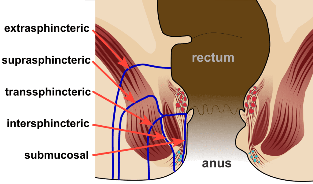 Illustration showing the different types of anal fistula.