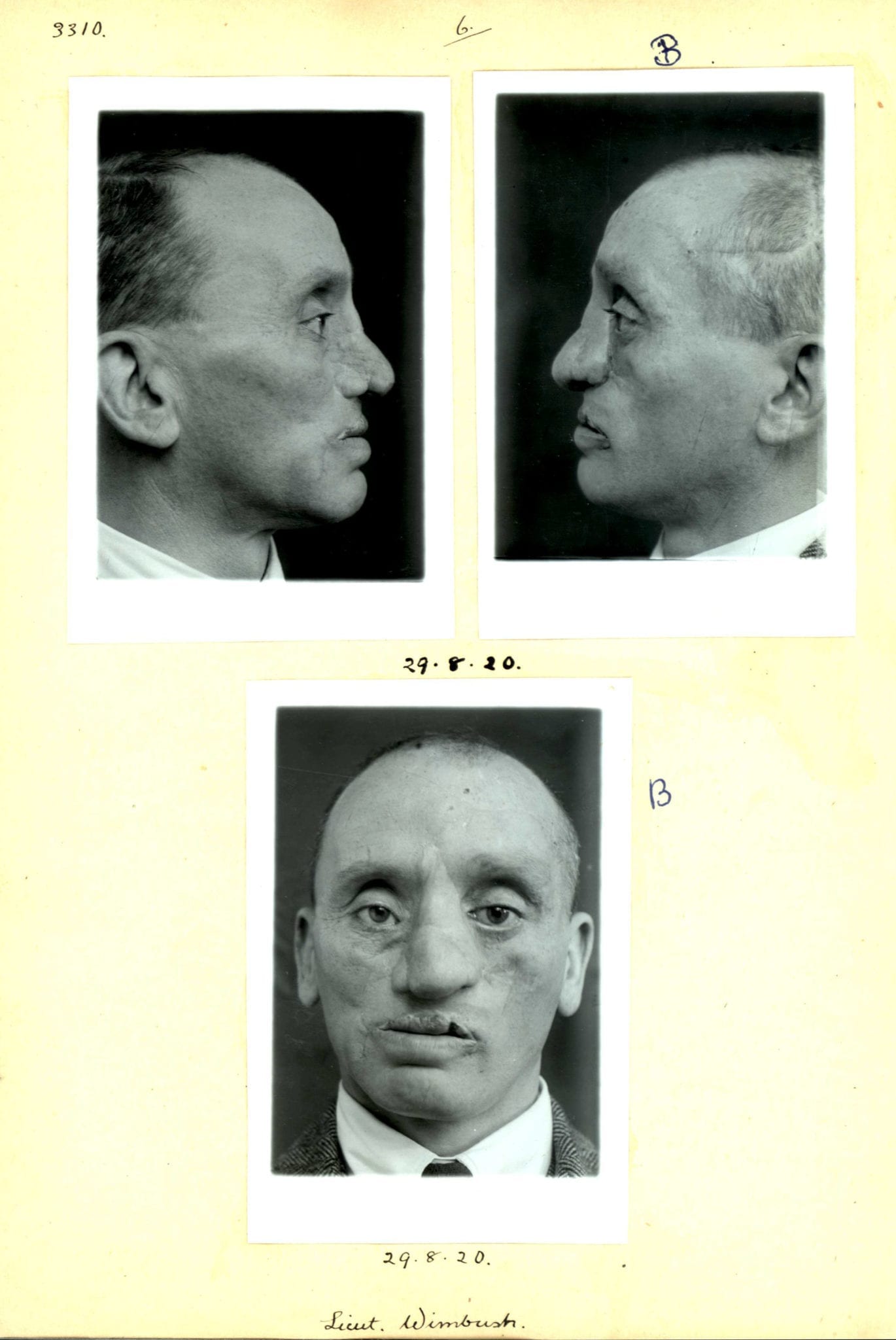 A series of black and white photographs showing the progression of reconstruction following facial injury.
