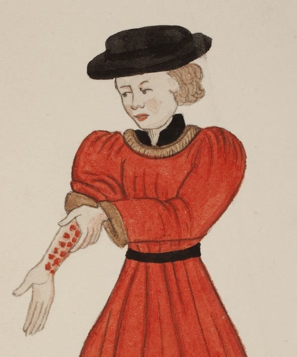 A man with a series of open wounds or ulcers on his arm. Illustration from De arte phisicali et de cirurgia of Master John Arderne, surgeon of Newark .