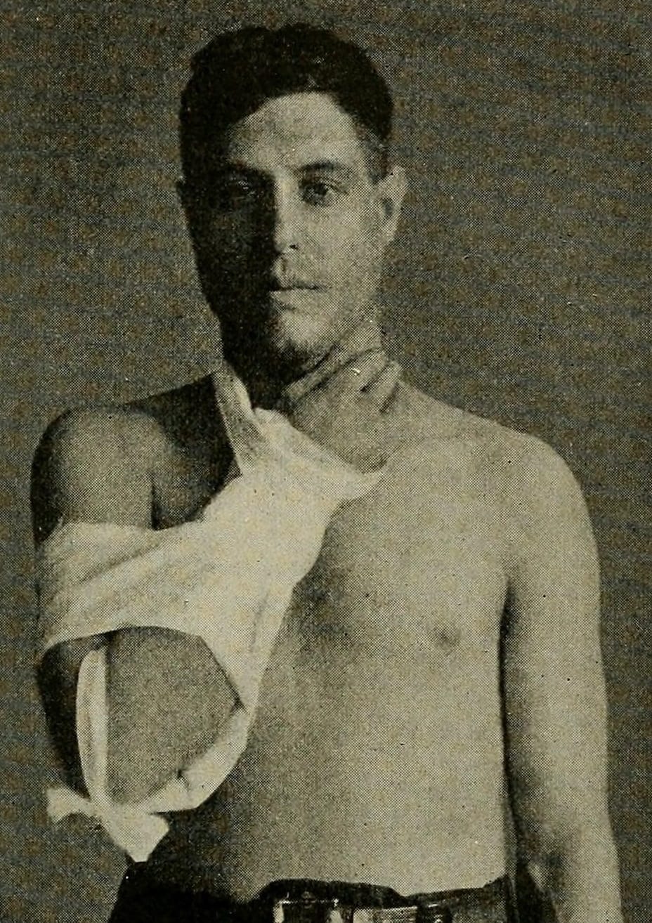 Man with his arm in splint to treat elbow fracture