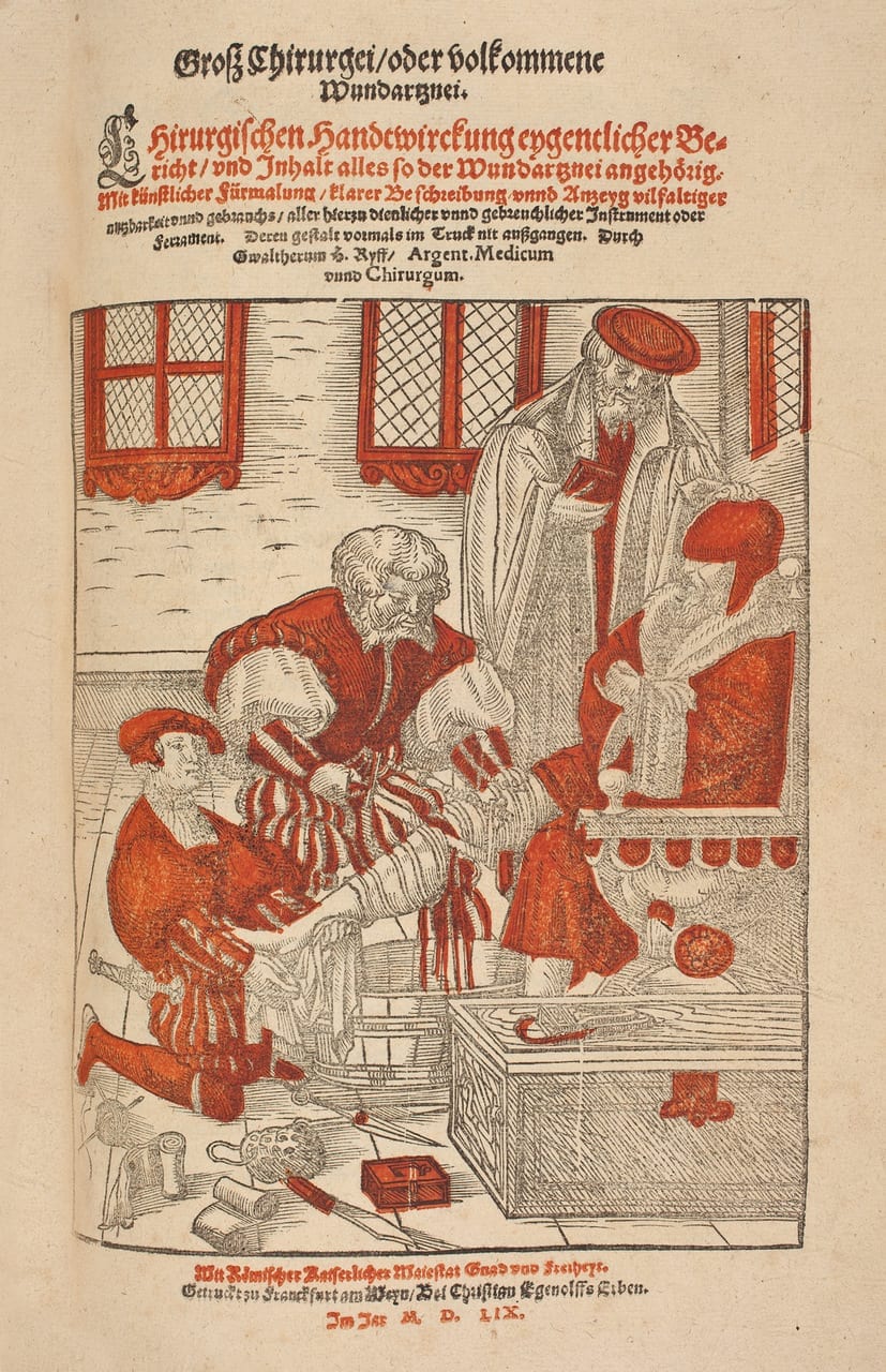 Illustration of a leg amputation from 1548