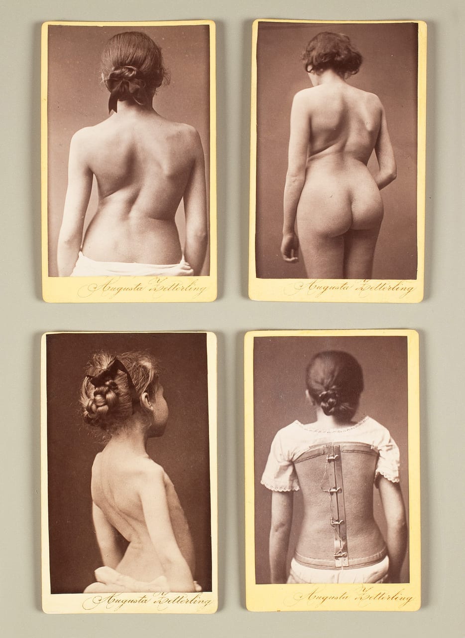 Series of photos of women with scoliosis
