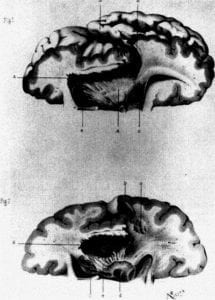 Black and white print of the brain of a woman labeled hysteric