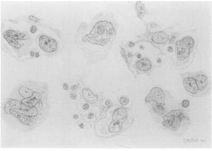 Reed’s original pencil illustration of the multi-nucleated Reed-Sternberg cells.