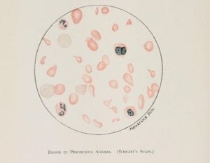 Illustration of blood cells affected by pernicious anemia