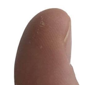 Photograph of a thumb with a callous, representative of Sanderson's thumb.