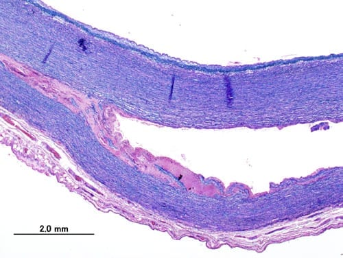Microscope image of aortic dissection
