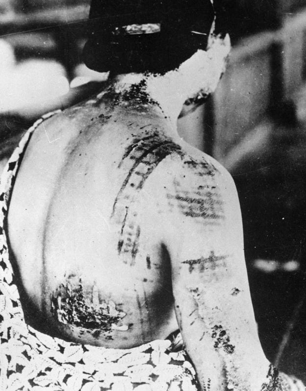 Burns from nuclear bomb at Hiroshima