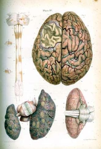 Illustration from Pathological Anatomy Illustrations of the Elementary Forms of Disease by Robert Carswell