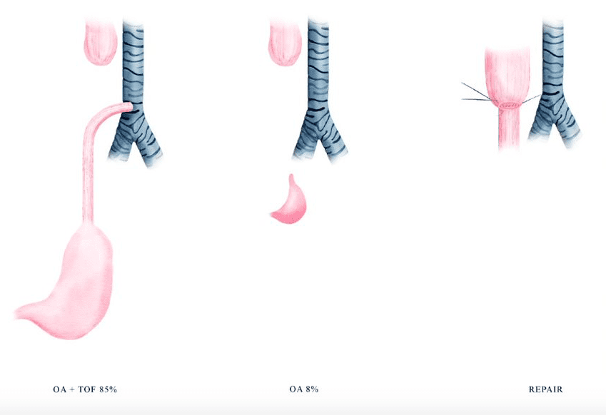 Illustration of esophageal atresia