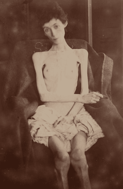 Woman suffering from anorexia nervosa, one idiom of distress.