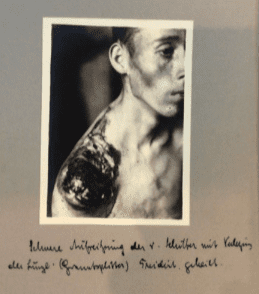 Photograph of wounded soldier taken by Ferdinand Sauerbruch