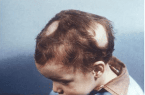 Child with tinea capitis, or ringworm infection of the scalp