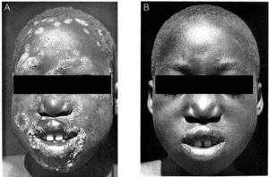 Yaws infection of face almost completely healed after one injection of penicillin.