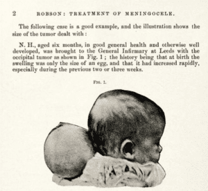 Text of AW Mayo-Robson's commentary on meningocele with photo of six month old child with large growth on back of neck and description that the growth was swelling rapidly over the past two or three weeks