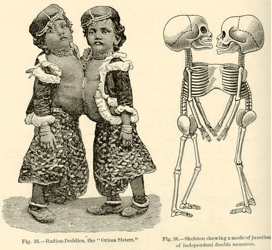Two children facing each other joined at the torso with skeletal sketch
